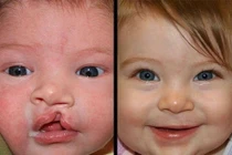 Thời điểm tốt nhất để phẫu thuật hở môi 