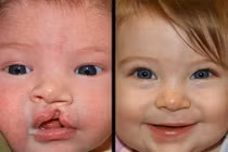 Thời điểm tốt nhất để phẫu thuật hở môi 