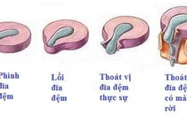 Nội soi “giải liệt” cho thoát vị đĩa đệm chèn ép ống sống