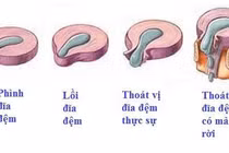 Nội soi “giải liệt” cho thoát vị đĩa đệm chèn ép ống sống