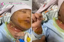 Ngại dịch COVID-19 không đến khám, bé 21 ngày tuổi viêm da mủ nặng