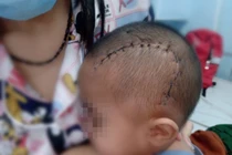 Nếu bệnh nhi được điều trị đúng ngay từ đầu, diễn tiến có thể đáp ứng thuốc mà không cần phẫu thuật vì áp xe não.