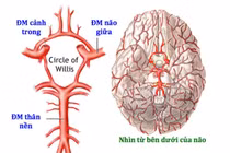  Bé 8 tuổi bị đột quỵ thiếu máu não cấp