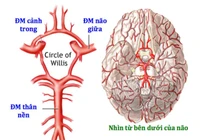  Bé 8 tuổi bị đột quỵ thiếu máu não cấp