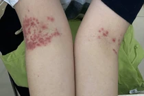 Ca mắc tay chân miệng hy hữu ở người lớn