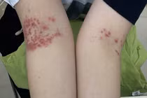 Ca mắc tay chân miệng hy hữu ở người lớn