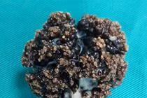 Khối u xơ tuyến tiền liệt to như quả cam