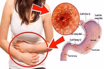 Viêm loét thực quản vì gây nôn giảm cân