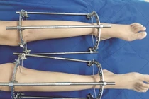 Kéo dài chân: Không chỉ giấc mơ chân dài