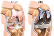 Những lưu ý khi thay khớp gối nhân tạo 