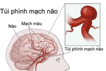 Cách trị dị dạng động tĩnh mạch não
