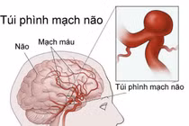 Cách trị dị dạng động tĩnh mạch não