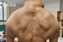 Biến thành dị dạng như “quái vật” vì uống 1 lít rượu/ngày