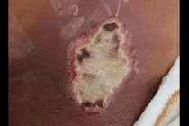 Lưng hoại tử vì đắp thuốc Nam trị mụn