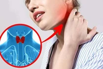Chẩn đoán bệnh tuyến giáp chính xác