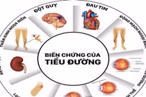 Chữa ho cho người tiểu đường bị ho kéo dài