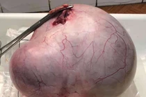 Cụ bà 67 tuổi mang u buồng trứng 3,7kg