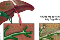  Vàng da, sốt do viêm đường mật xơ hóa