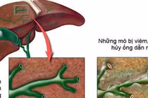  Vàng da, sốt do viêm đường mật xơ hóa