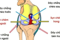 Tổn thương dây chằng khớp sau mổ hay điều trị?