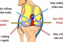 Tổn thương dây chằng khớp sau mổ hay điều trị?