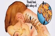 Hội chứng bệnh lý gây thoái hóa cột sống cổ