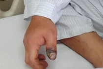 Sai lầm khi sơ cứu rắn cắn bằng biện pháp dân gian