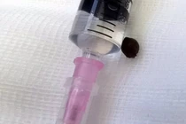 Hạt tiêu được lấy ra khỏi phổi bệnh nhân