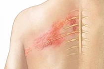 Zona thần kinh kéo dài bao lâu? Xem ngay thảo dược giúp cải thiện bệnh hiệu quả