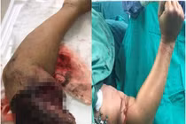 Bảo quản chi thể đứt rời đúng cách 