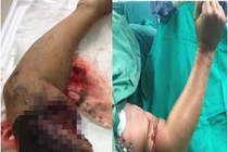 Bảo quản chi thể đứt rời đúng cách 