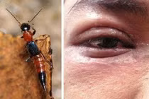 Sai lầm khiến bạn trúng độc kiến ba khoang