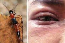 Sai lầm khiến bạn trúng độc kiến ba khoang