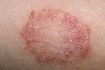 Mọc nấm sau khi quan hệ không an toàn