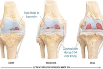 4 giai đoạn của thoái hóa khớp gối