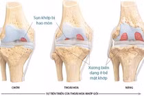 4 giai đoạn của thoái hóa khớp gối