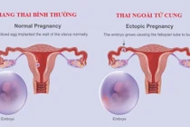 Suýt mất mạng vì chửa ngoài tử cung