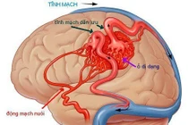 Mất mạng vì chủ quan với đau đầu