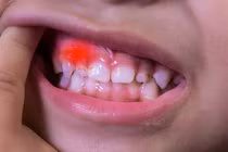 Viêm nướu có mủ và những thông tin không thể bỏ qua