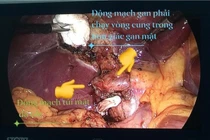 Bất thường động mạch túi mật