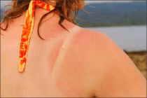 Chăm sóc da bị cháy nắng