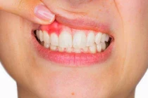 Những nguyên nhân cần lưu ý khi xuất hiện tình trạng chảy máu nướu khi đánh răng