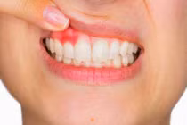 Những nguyên nhân cần lưu ý khi xuất hiện tình trạng chảy máu nướu khi đánh răng