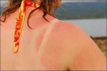 Chăm sóc da bị cháy nắng