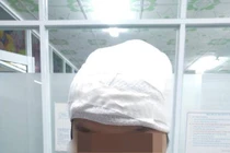 Vi phẫu tạo hình cho bé gái bị mất nửa phần da đầu 