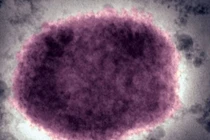 Virus đậu mùa khỉ trong mụn nước ở người bệnh.