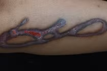 Sẹo phì đại sau xóa xăm