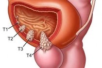 U bàng quang mới phát hiện, có nên mổ?