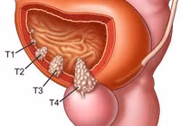 U bàng quang mới phát hiện, có nên mổ?