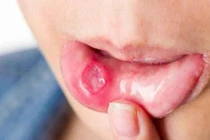 Cách phòng tái phát loét miệng
